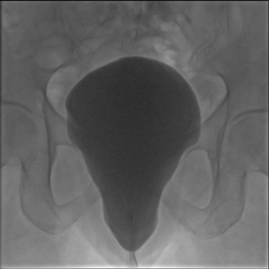 bladder prolapse severe cystometrogram serag youssif
